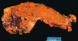 pancreatitis-acute organ